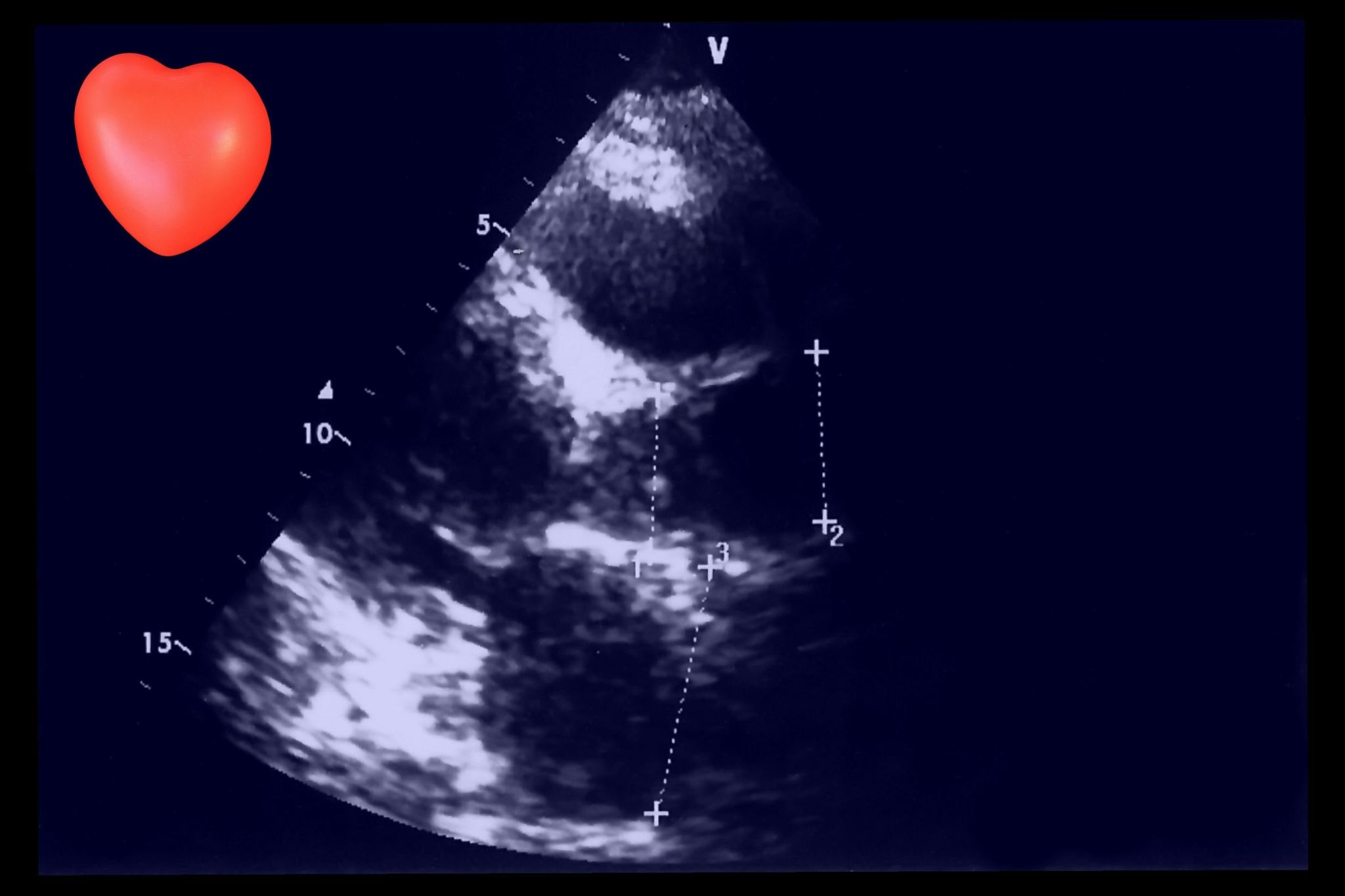 Cardiomyopathy