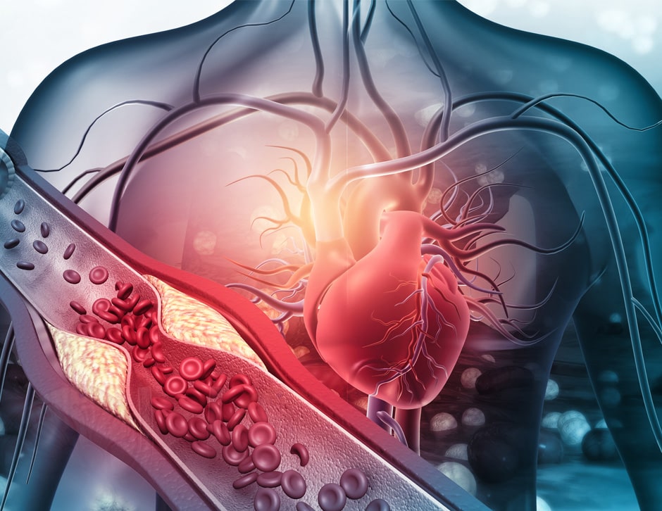 Coronary Artery Disease
