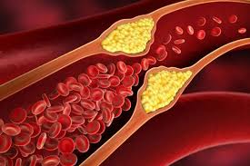 Hyperlipidemia